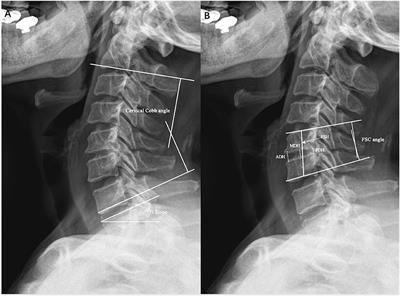 Comparative Analysis of Cage Subsidence in Anterior Cervical Decompression and Fusion: Zero Profile Anchored Spacer (ROI-C) vs. Conventional Cage and Plate Construct